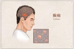 黑龍江省治療癲癇好醫院